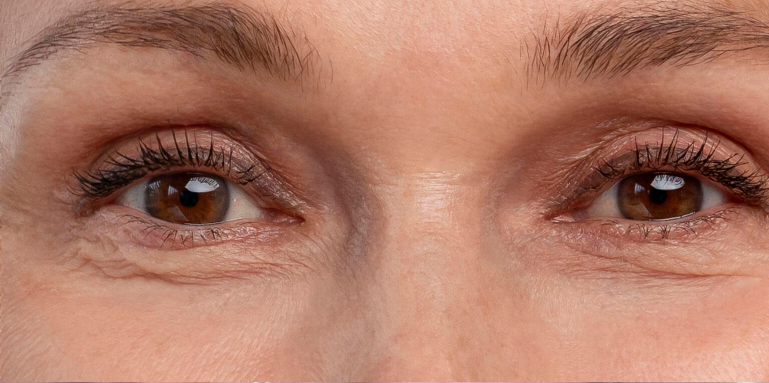 After Botox: smooth skin around the eyes