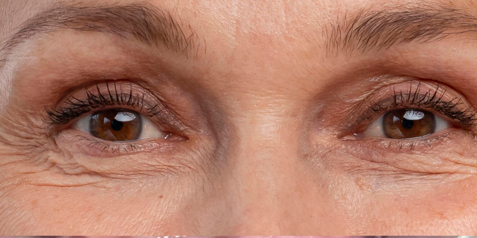 Before Botox: fine lines around the eyes