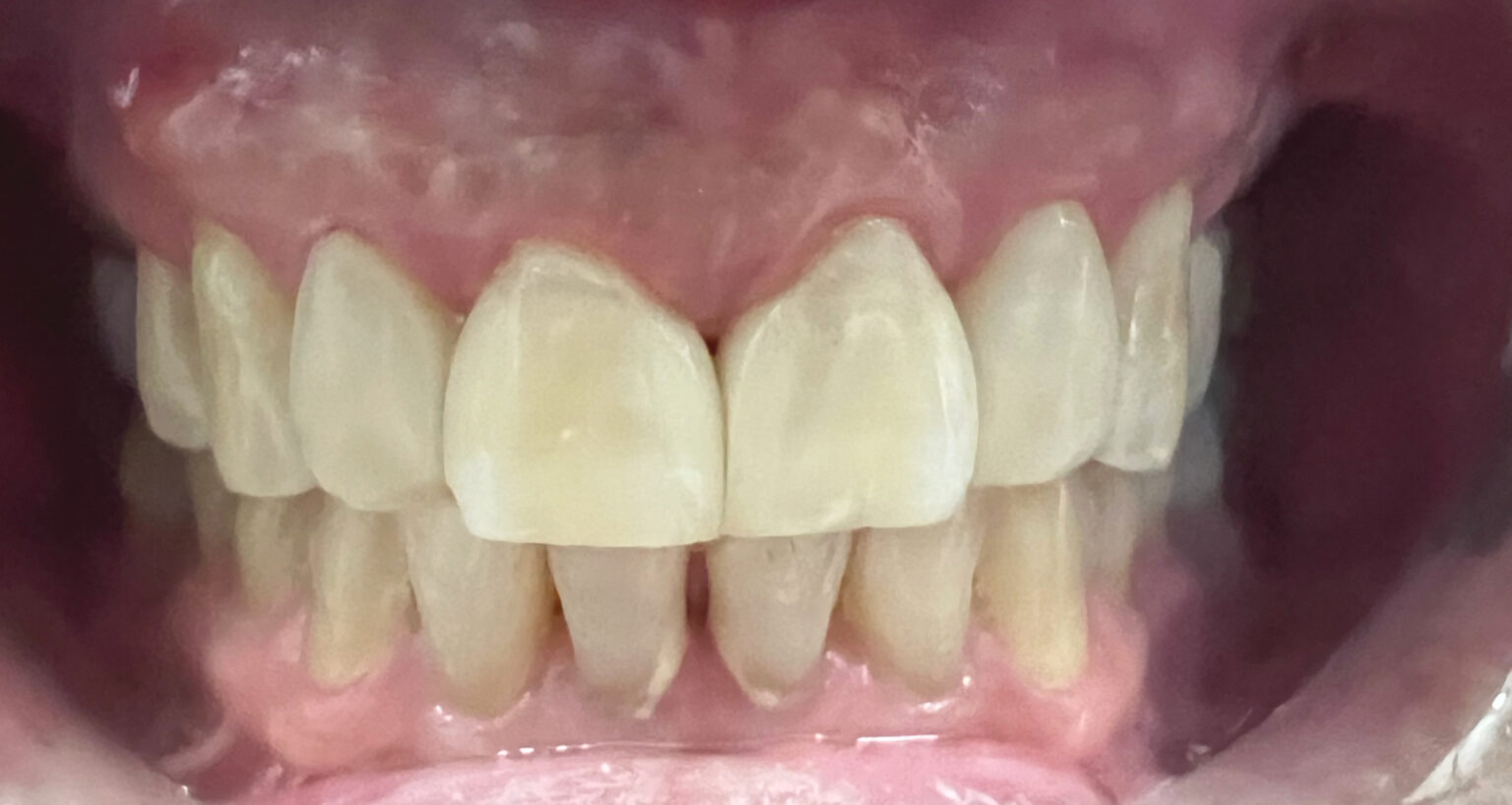 After: the gap between the front teeth is closed