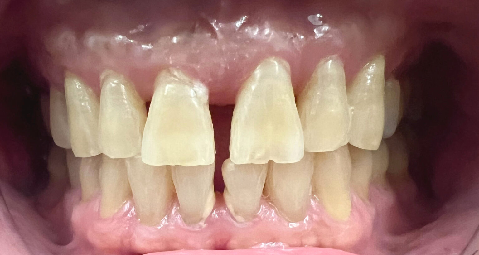 Before: a dark triangle gap between the front teeth