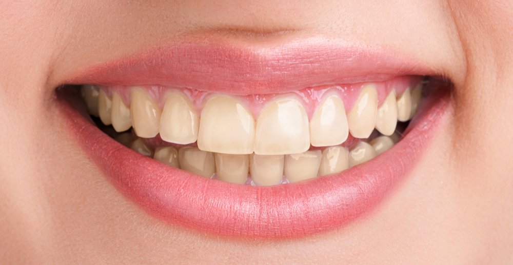 Before whitening: yellowed teeth