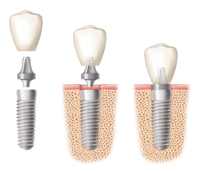 Illustration of an implant crown, abutment, and titanium implant, shown apart and assembled in the jawbone